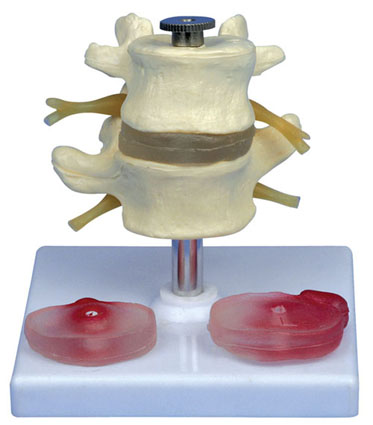 腰椎带3个病变椎间盘模型