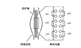 肌电表面电极的应用举例